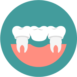 Dental Bridges